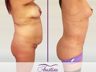 Lipo abdominoplastia con trnsferencia de grasa y levantamiento mamario