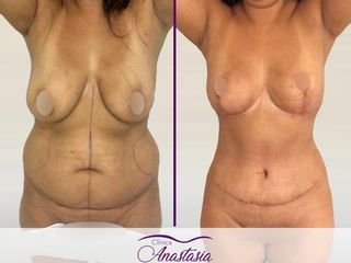 Lipo abdominoplastia con reducción mamaria