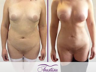 Lipoescultura con aumento mamario