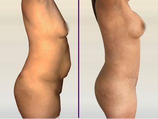 Lipo abdominoplastia con aumento mamario