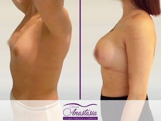 Aumento Mamario con protesis
