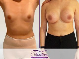 Aumento Mamario con protesis