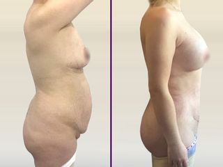 Lipo abdominoplastia con aumento mamario