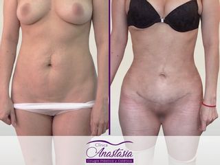 Lipo abdominoplastia