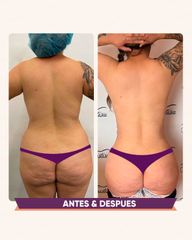 Liposucción - Clínica Anastasia
