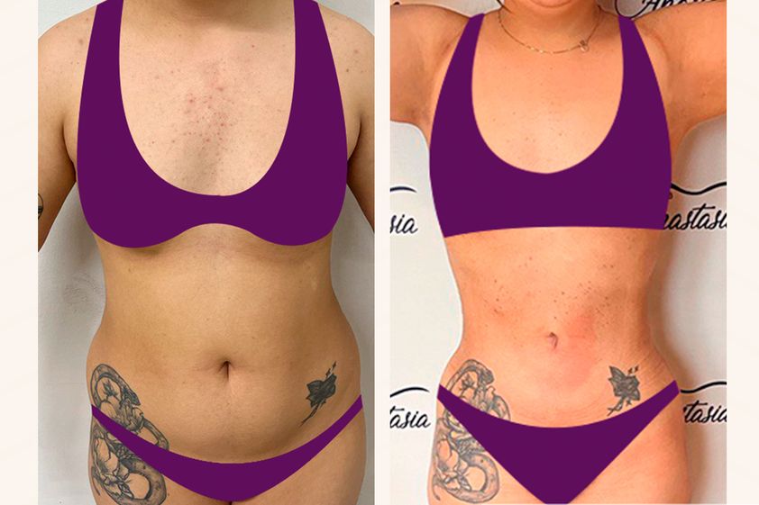 Lipoescultura antes y después - 858457