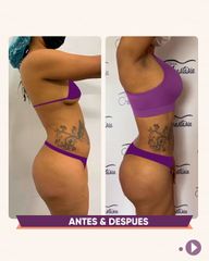Abdominoplastia - Clínica Anastasia