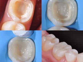 Implantes dentales - 815251