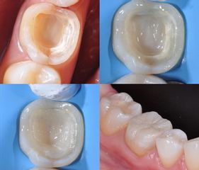 Implante dental - Clínica Océano