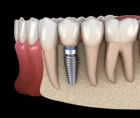Implante dental - Clínica Océano
