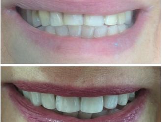 Carillas de porcelana - 569480