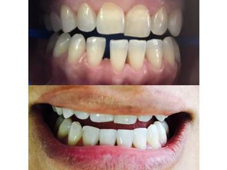 Carillas de porcelana - 576879