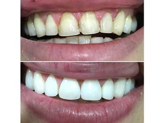 Carillas de porcelana - 590456