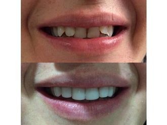 Carillas de porcelana - 590457