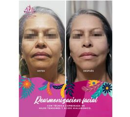 Rejuvenecimiento Facial