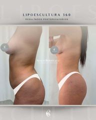Lipoescultura