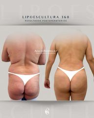 Lipoescultura - Dra. Adalis Amanda Rodríguez