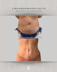 LIPO + ABDOMINOPLASTIA - Dra. Adalis Amanda Rodríguez