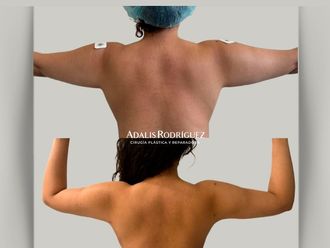 Liposucción antes y después - 874955