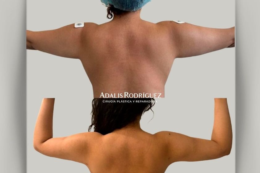 Liposucción antes y después - 874955
