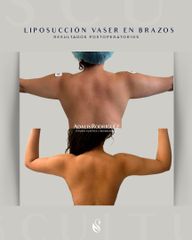 Liposucción vaser en Brazos - Dra. Adalis Amanda Rodríguez