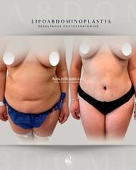 Lipoescultura y Abdominoplastia -Dra. Adalis Amanda Rodríguez