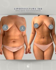 Lipoescultura - Dra. Adalis Amanda Rodríguez