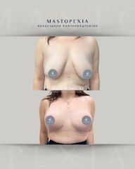 Mastopexia - Dra. Adalis Amanda Rodríguez