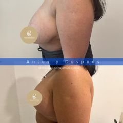 Reducción de Pecho -Dra. Adalis Amanda Rodríguez