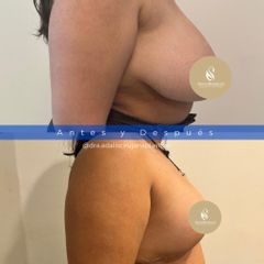 Reducción de Pecho - Dra. Adalis Amanda Rodríguez