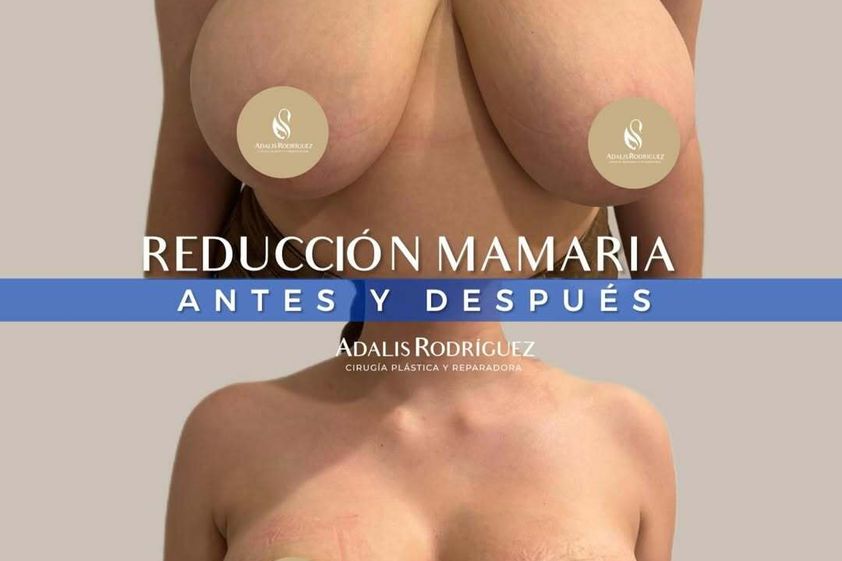 Reducción mamaria antes y después - 874963