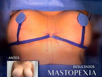 Mastopexia antes y después - 874964