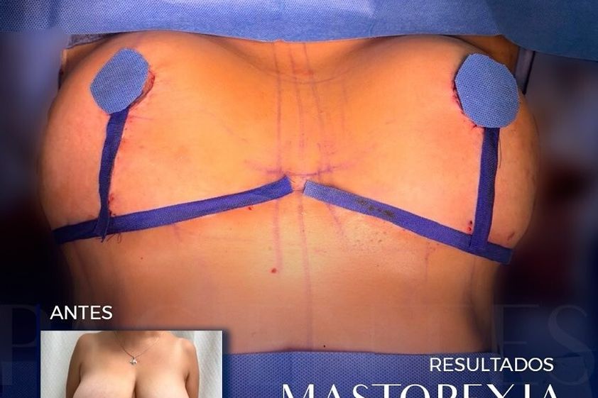 Mastopexia antes y después - 874964
