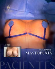 Mastopexia - Dra. Adalis Amanda Rodríguez