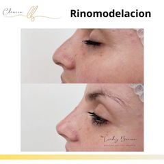 Rinomodelación - Clinica Dra. Leidy Boscan