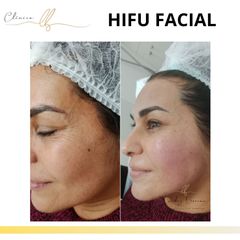 HIFU - Clinica Dra. Leidy Boscan