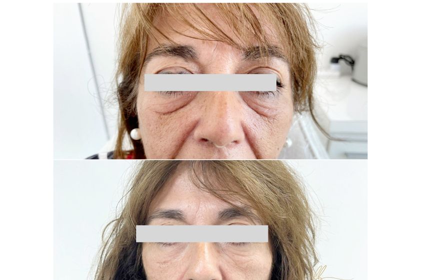 Tratamiento de ojeras antes y después - 856673