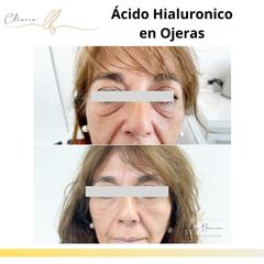 Tratamiento de ojeras - Clinica Dra. Leidy Boscan