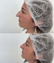 Rinomodelación - Clinica Dra. Leidy Boscan