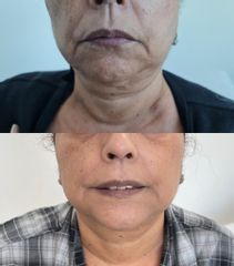 Hilos tensores - Clinica Dra. Leidy Boscan