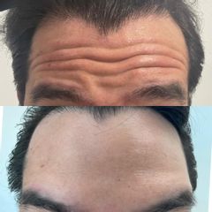Bótox - Clinica Dra. Leidy Boscan