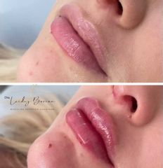 Aumento de labios - Clinica Dra. Leidy Boscan