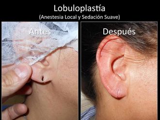 Otoplastia - 631599