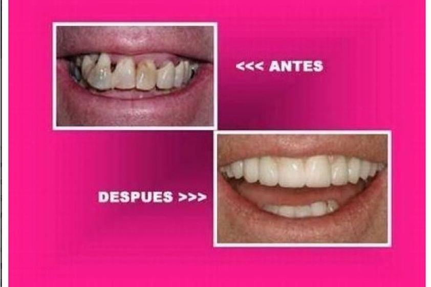 Carillas dentales antes y después - 573482