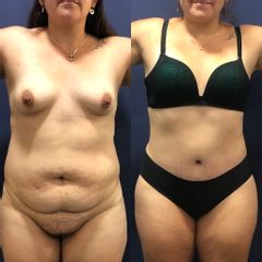 Abdominoplastia - Clínica Medystetic