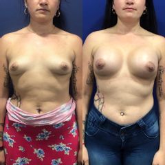Mastopexia - Clínica Medystetic