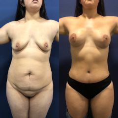 Lipoescultura - Clínica Medystetic