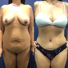 Abdominoplastia - Clínica Medystetic