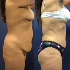 Abdominoplastia - Clínica Medystetic