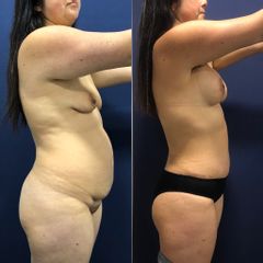 Lipoescultura - Clínica Medystetic